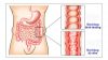 Những triệu chứng của viêm đại tràng bạn cần lưu ý